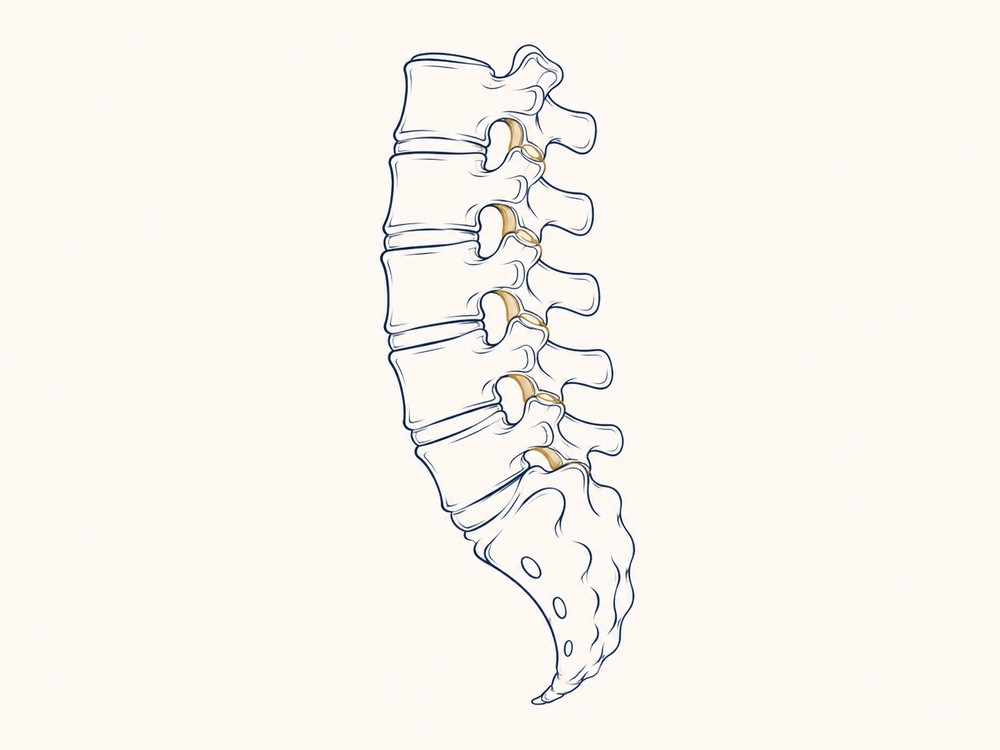 Ilustração da coluna lombar em vista lateral, destacando as articulações tratadas pela radiofrequência
